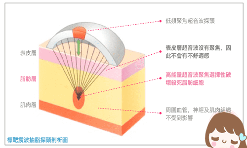 优立塑减肥后遗症 优立塑减肥的副作用