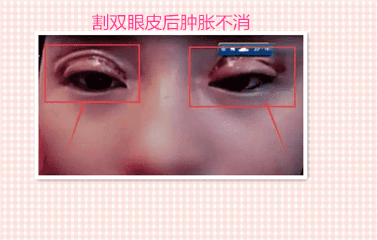 割双眼皮失败案例图片 切双眼皮失败案例