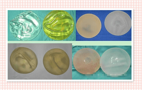 假体隆胸取出后图片 隆胸假体取一月图片