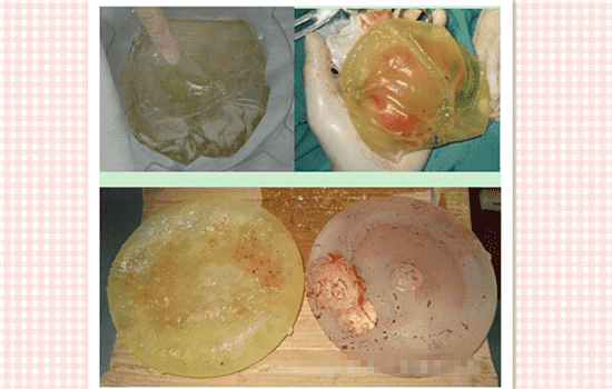 假体隆胸取出后图片 隆胸假体取一月图片