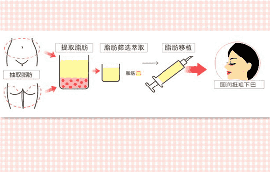 自体脂肪填充全脸痛吗 全脸脂肪填充痛不痛