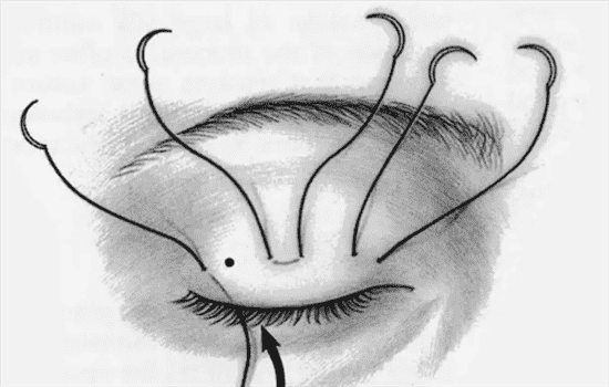 埋线双眼皮能保持永久吗 埋线双眼皮可以保留多久多久