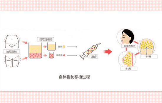 自体隆鼻能保持多久 自体隆鼻能保持终生吗