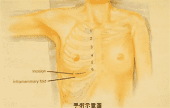 肋软骨隆鼻后遗症 肋软骨隆鼻的坏处