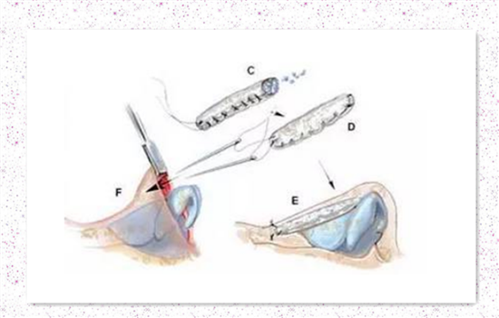 耳软骨垫鼻子后遗症吗 软骨隆鼻后遗症