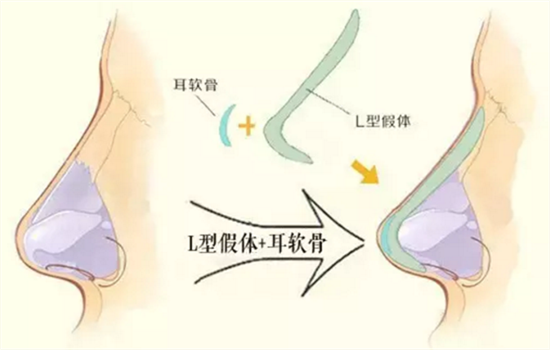 鼻综合包括哪些项目 鼻综合包括哪些隆鼻吗