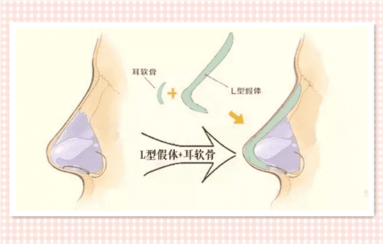 鼻综合恢复期要多久 鼻综合多久恢复自然