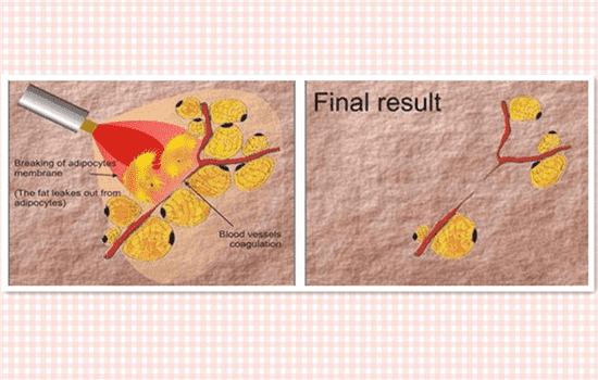 激光溶脂瘦脸副作用 激光溶脂瘦脸的危害