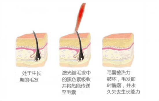 光子脱毛和激光脱毛区别 激光脱毛和光子脱毛哪个好