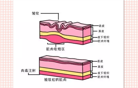 肉毒素除皱原理 肉毒素去皱原理