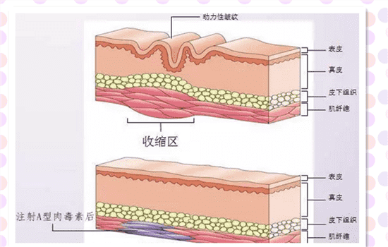 肉毒素除皱原理 肉毒素去皱原理