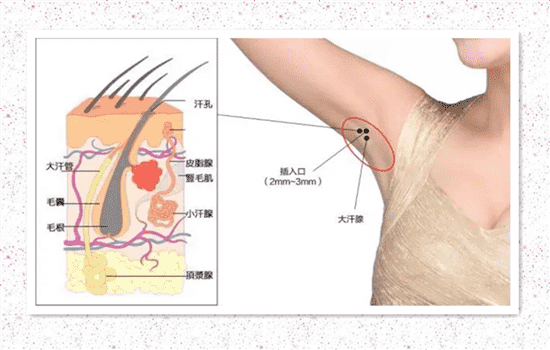 腋臭手术有什么危害 做腋臭手术的危害