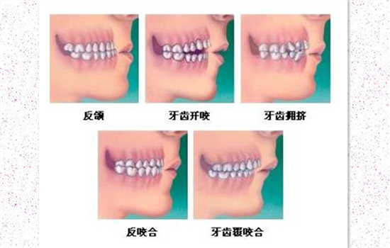 牙齿整形的年龄限制吗 牙齿整形的最佳年龄