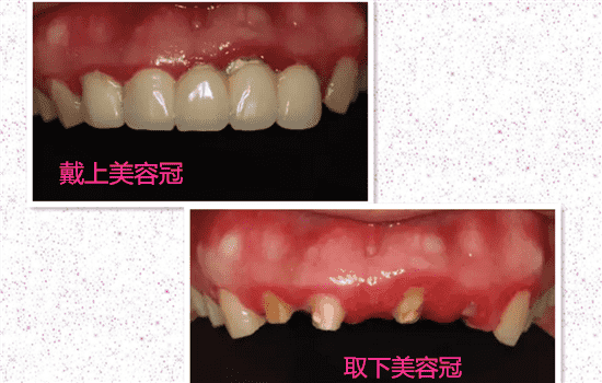 美容冠矫正牙齿好吗 美容冠矫正好不好