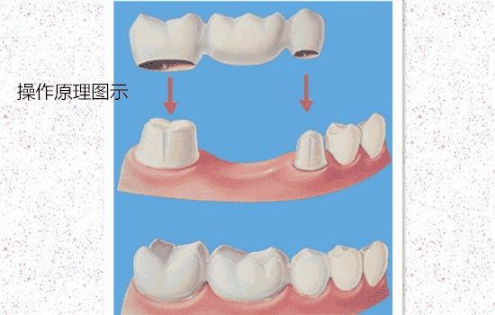 烤瓷牙和全瓷牙区别 烤瓷牙与全瓷牙有什么区别