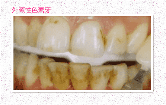 超声波洗牙会变白吗 超声波洁牙会变白吗