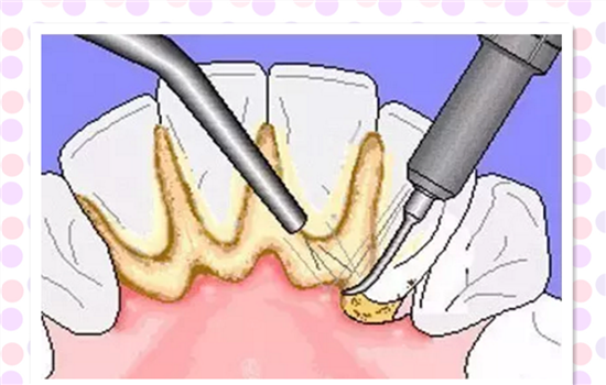超声波洗牙的原理 超声波洗牙是怎么洗的