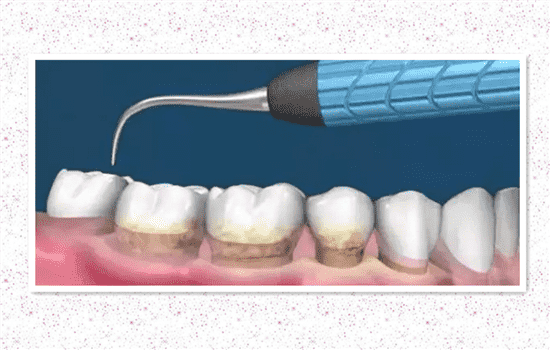 超声波洗牙的原理 超声波洗牙是怎么洗的