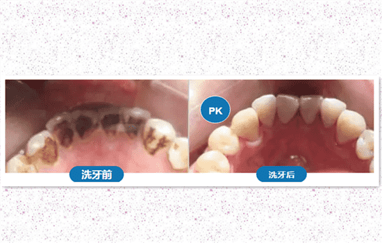 洗牙疼吗 洗牙疼不疼