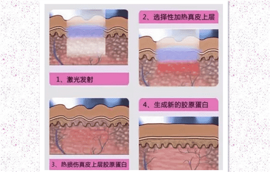 激光祛痘效果怎么样 激光祛痘效果如何呢