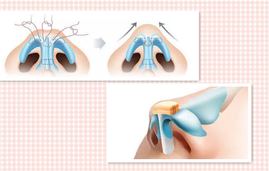 蒜头鼻怎么整形 蒜头鼻怎么整容