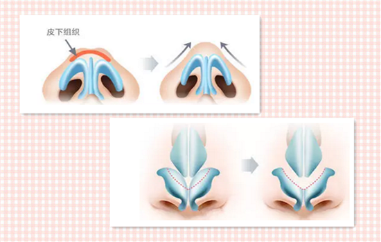 蒜头鼻怎么整形 蒜头鼻怎么整容