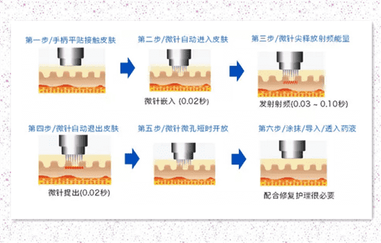 微针的功效 微针的作用