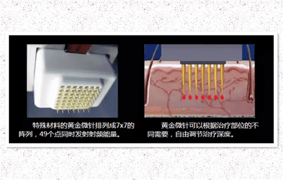 微针去疤痕管用吗 微针去凹疤实际效果