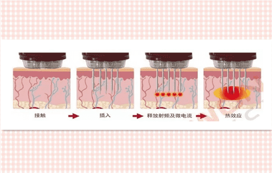 微针去疤痕管用吗 微针去凹疤实际效果