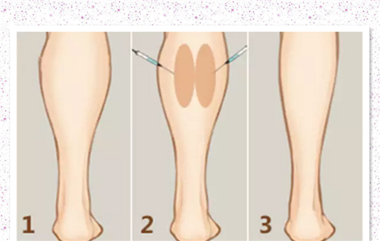 瘦腿针和抽脂哪个好 抽脂好还是打瘦腿针好