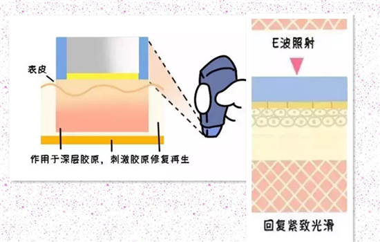 热玛吉什么原理 热玛吉的原理