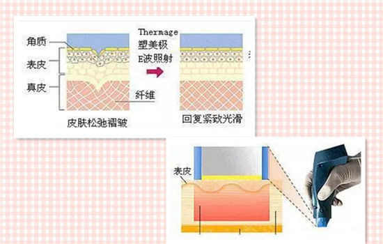 做热玛吉脸部塌陷 热玛吉凹凸洞