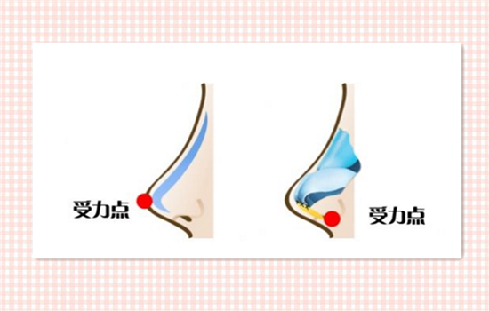 耳软骨垫鼻尖会穿出吗 耳软骨垫鼻尖会顶破吗