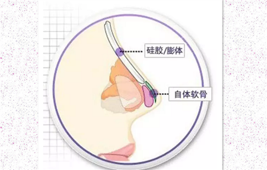 耳软骨隆鼻痛吗 耳软骨隆鼻拆线疼吗