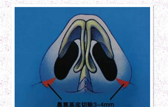 鼻翼外切有疤痕怎么办 鼻翼缩小外切疤痕