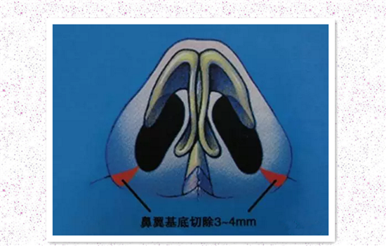 缩鼻翼内切外切原理图 鼻翼外切示意图