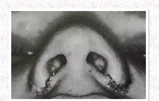缩鼻翼内切外切原理图 鼻翼外切示意图