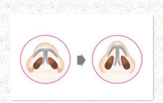 鼻翼缩小多久看到效果 鼻翼外切效果