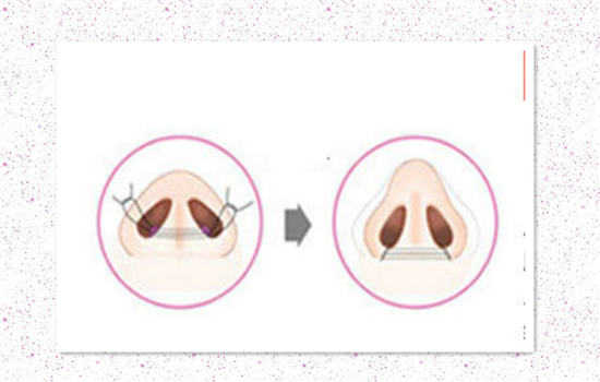 鼻翼缩小多久看到效果 鼻翼外切效果