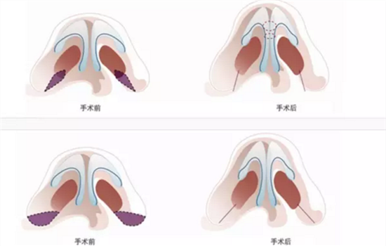 鼻头缩小术过程图 鼻头缩小的手术过程