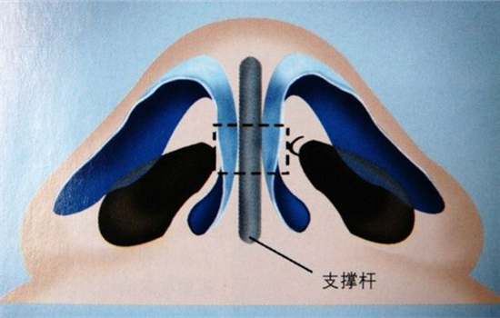 鼻头缩小术过程图 鼻头缩小的手术过程