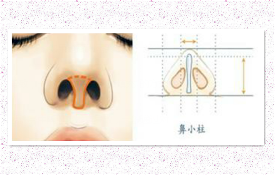 鼻小柱延长原理图示 鼻小柱延长手术图解