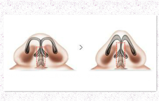 鼻小柱延长原理图示 鼻小柱延长手术图解