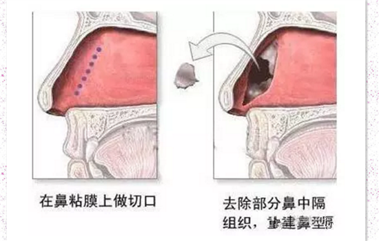 鼻小柱延长是延长哪里 鼻小柱延长是垫鼻尖吗