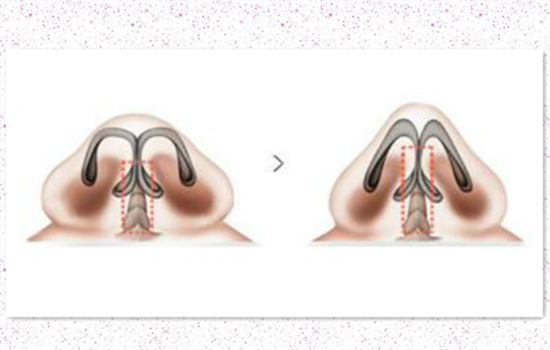 鼻小柱延长方法 如何延长鼻小柱