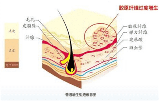 切眉手术疤痕怎么办 切眉留下疤痕怎么办