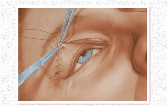 全切双眼皮过程 切开双眼皮的过程图解