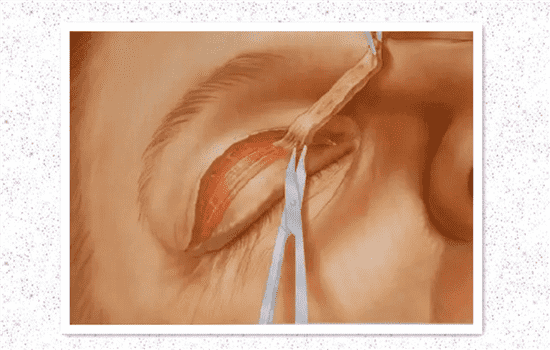 全切双眼皮过程 切开双眼皮的过程图解