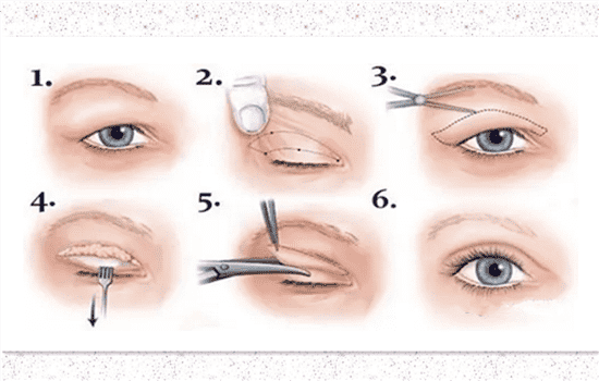 双眼皮切开法优缺点