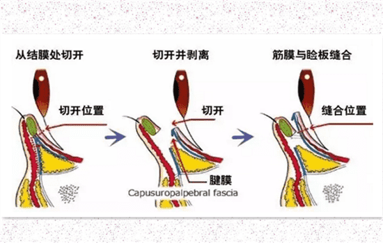 开外眼角和眼睑下至的区别 开后眼角和下至